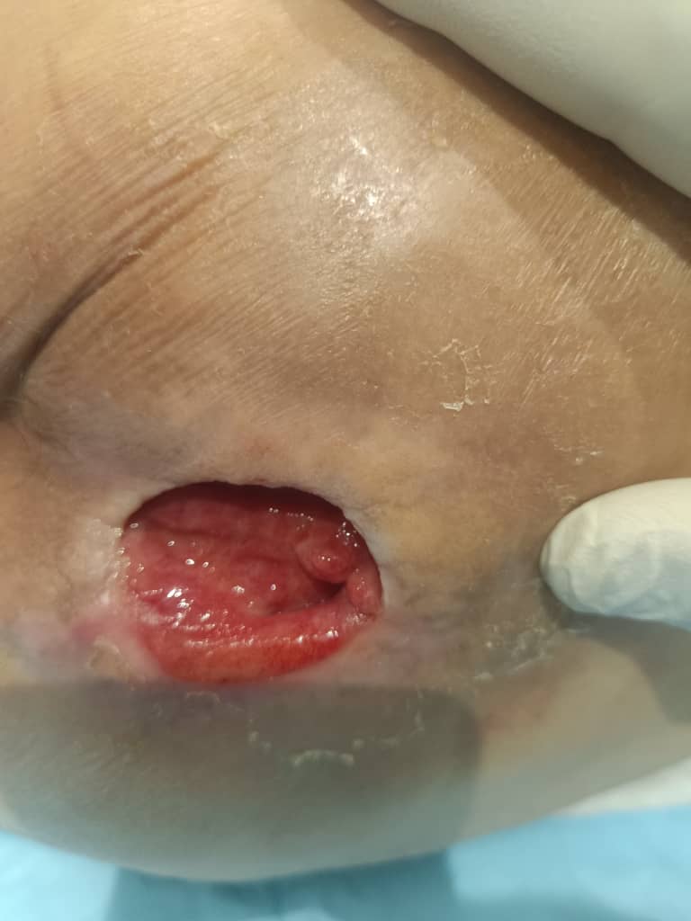 زخم بستر در حال ترمیم