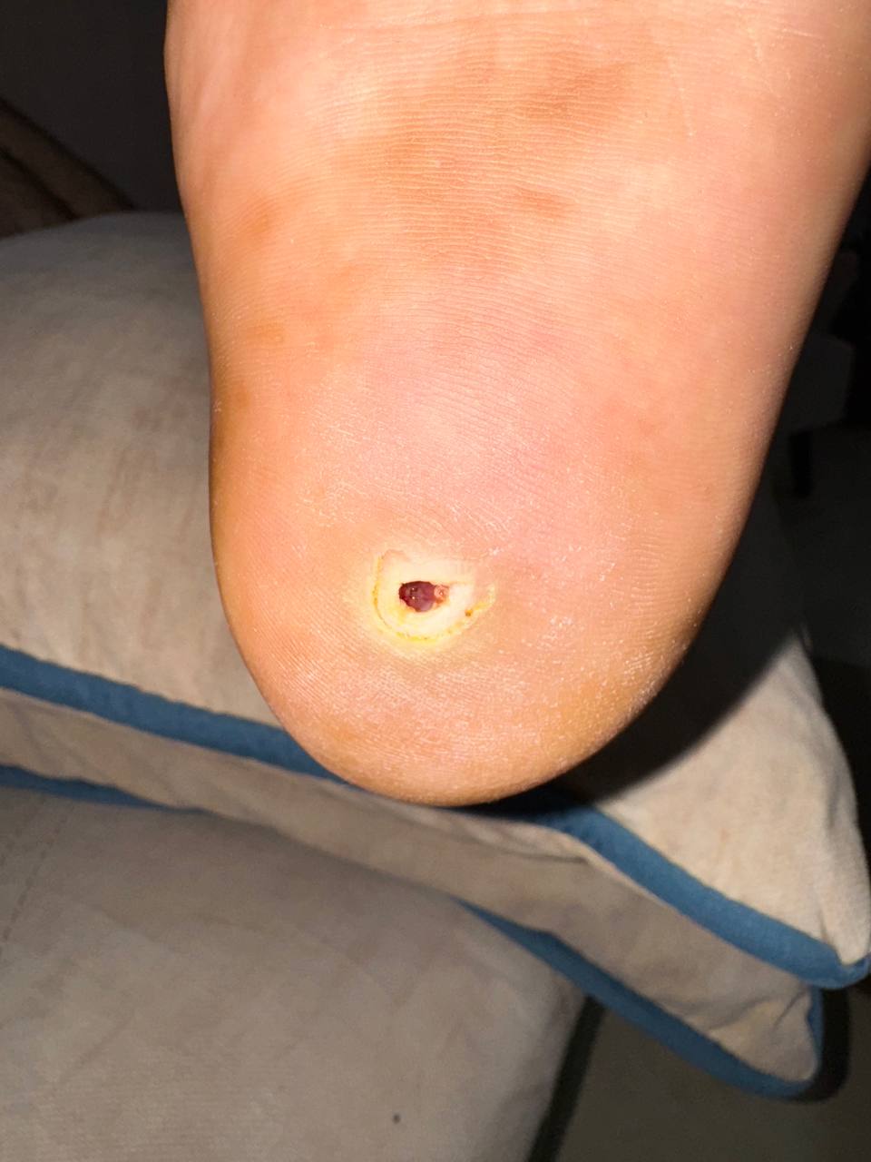 درآوردن جسم خارجی